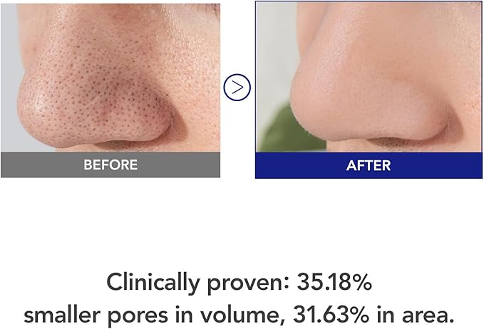 35% Smaller Pores & 32% Reduced Pore Area – Improves Skin Texture by 8% – Soothes, Hydrates & Brightens with CICA Exosomes, AHA/BHA/PHA & Fruit Enzymes – Korean Skincare Favorite Toner Pad Kioskin