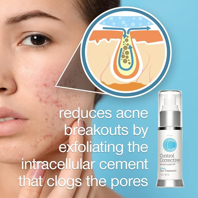 CONTROL CORRECTIVE Acne Spot Treatment Gel – 2% Salicylic Acid + Glycolic Acid Formula for Breakouts & Blemishes – With Witch Hazel, Aloe & Panthenol – 1 oz Clear Skin Serum
