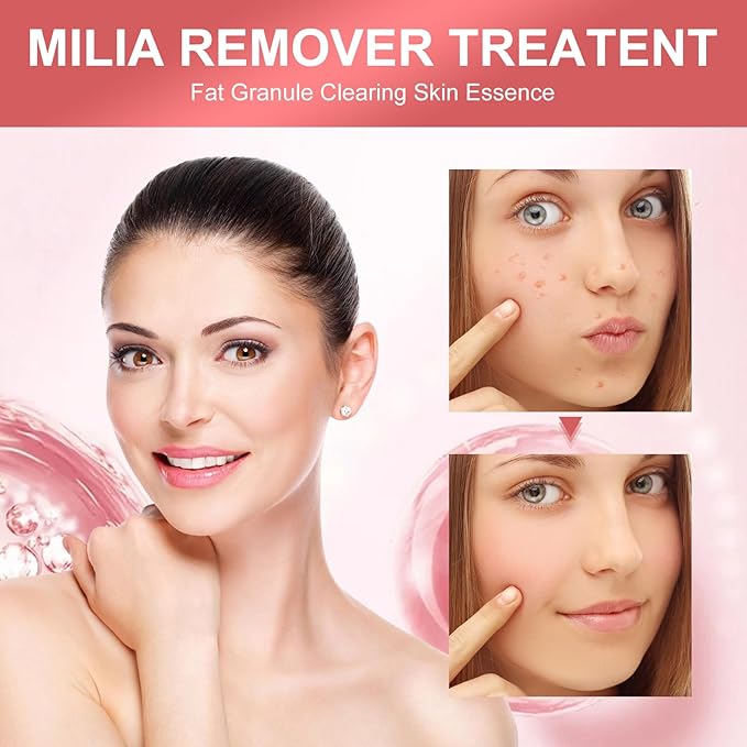 Milia Remover with Salicylic Acid, Milia Spot Remover, Gentle Milia Serum for Face& Eye
