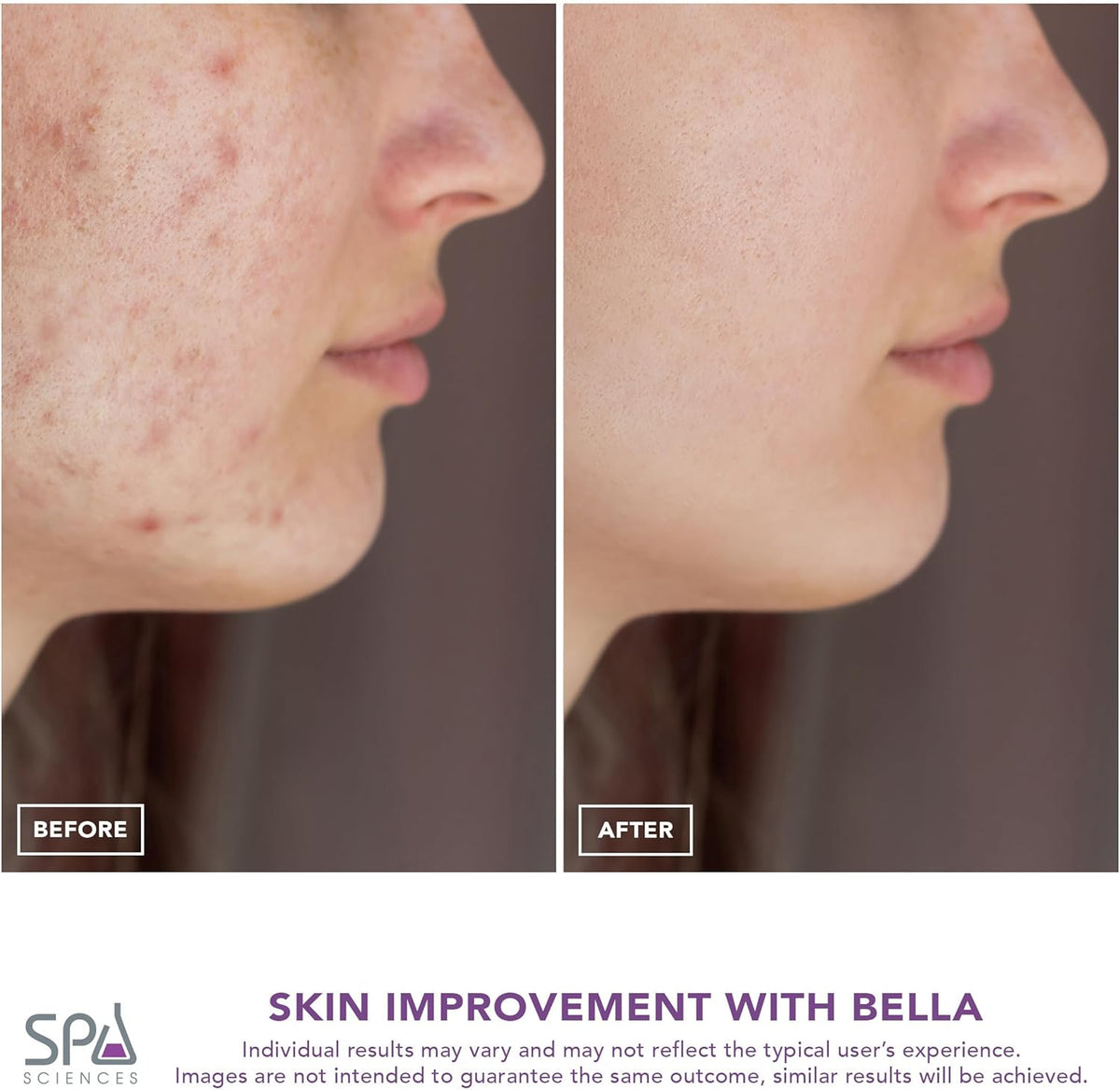 Spa Sciences - BELLA Microderm Pore Extractor & Nano Mister - 3-in-1 - Exfoliation & Pore Purification - Hydrating, Refreshing, Soothing - for All Skin Types - USB Charging