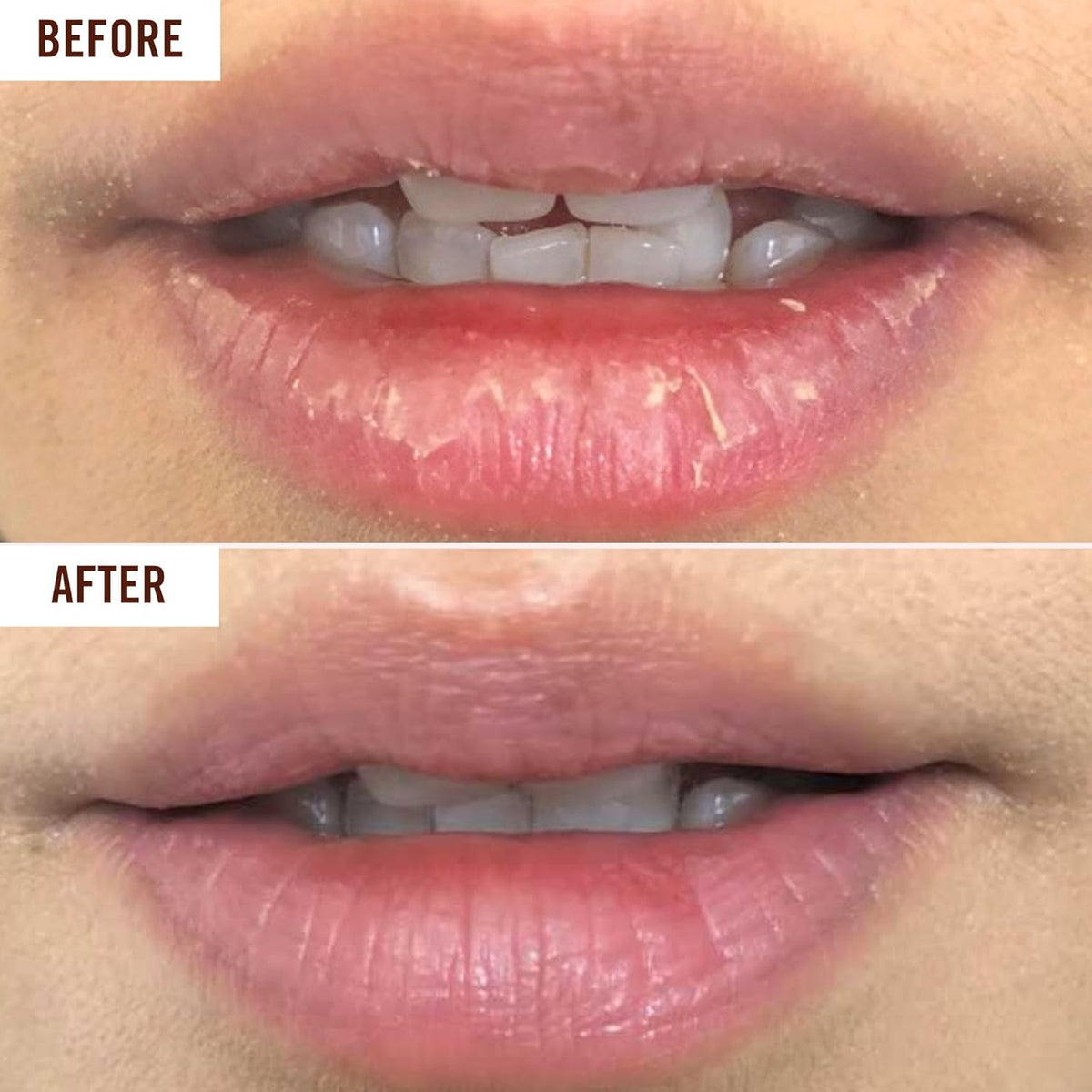 Hanalei Lip Treatment for Dry, Chapped Lips – Intensive Overnight Moisturizer with Kukui Oil, Shea Butter & Grapeseed Oil – Hydrating Balm for Healing Cracks – Clear Tint, Full-Size 15g – Cruelty-Free