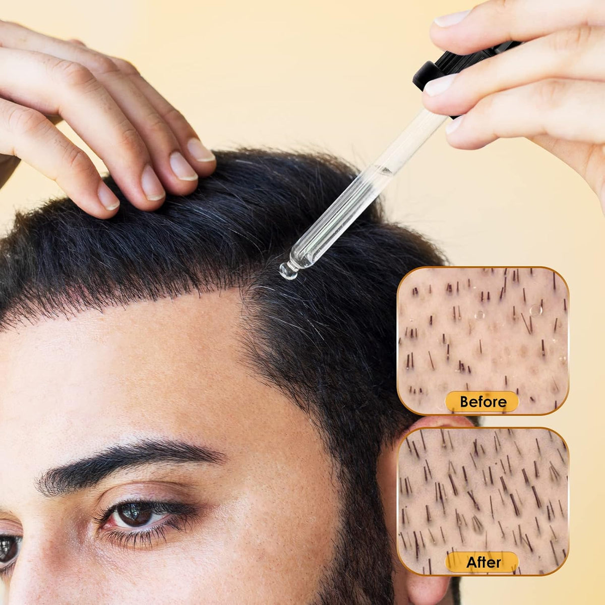 5% Minoxidil for Men & Women Hair Growth - Biotin Minoxidil Serum Oil for Beard Growth Stop Hair Thinning and Hair Loss For Stronger Thicker Longer Hair