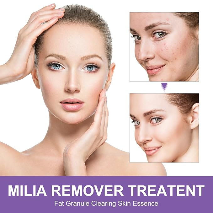 Milia Remover Cream for Eyes & Face,Milia Spot Treatment with Salicylic Acid,Milia Acne Cream