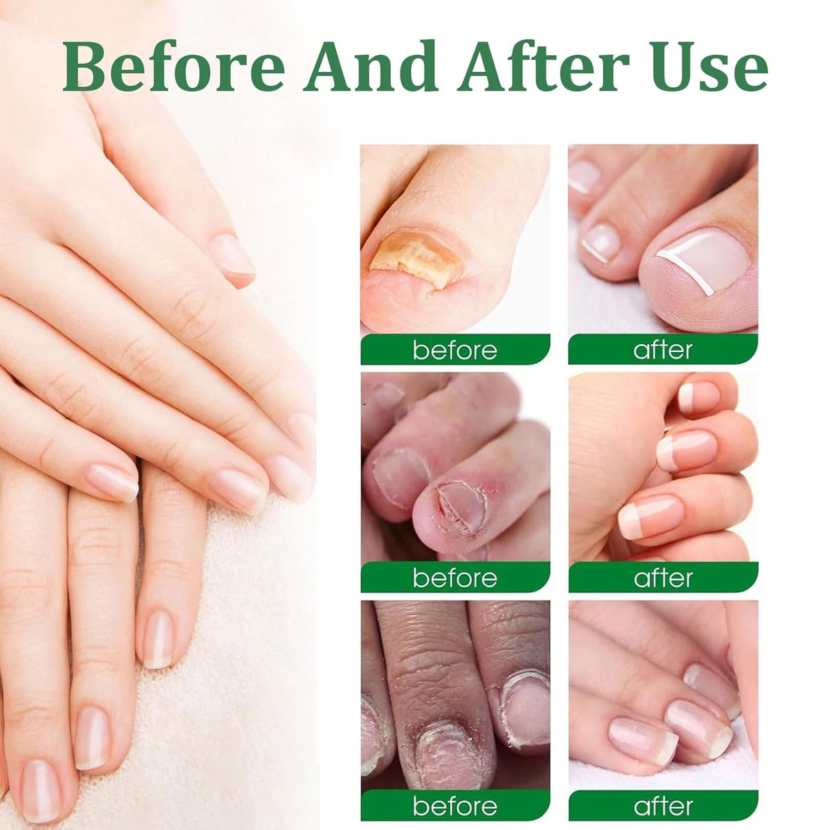 Nutraboost Nail Treatment Gel, Nail Growth Serum for Repair & Strengthener, Multi-Purpose Nail Repair Serum (2)