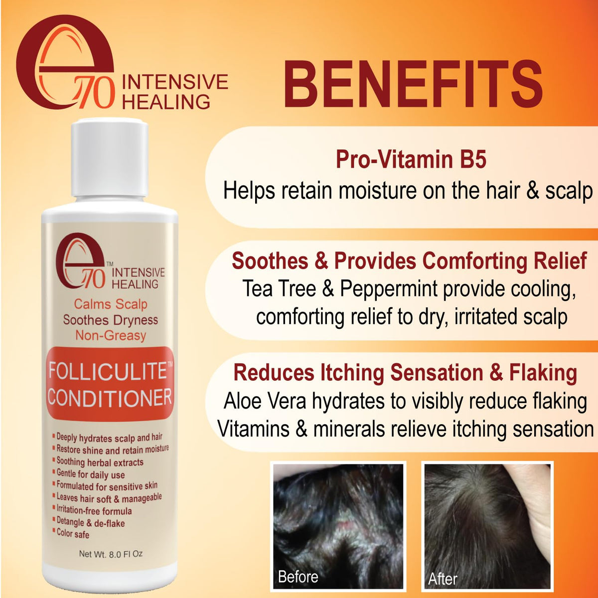 Folliculitis Treatment Conditioner with 3% BHA, Salicylic Acid, Tea Tree Oil & Chamomile Extracts - Anti Itch for women & men with Irritated Flaky Scalp Acne Treatment, Made in USA, 8 fl oz