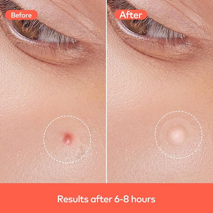 Hydrocolloid Acne Spot Patch for Face – Fast-Acting, Invisible, Healing & Protective, 36 Count