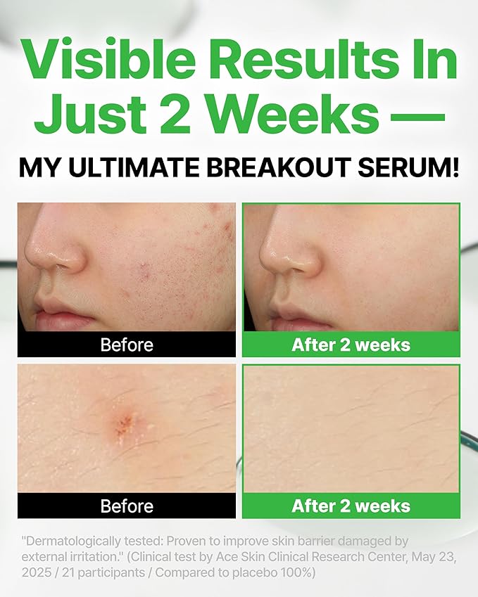 Trouble Targeting Serum, Hydrating & Balancing Face Serum with Niacinamide, Hyaluronic Complex & Tea Tree Biome for Oily Sensitive Blemish-Prone Skin, Korean Skincare (30ml / 1.01 fl.oz.)