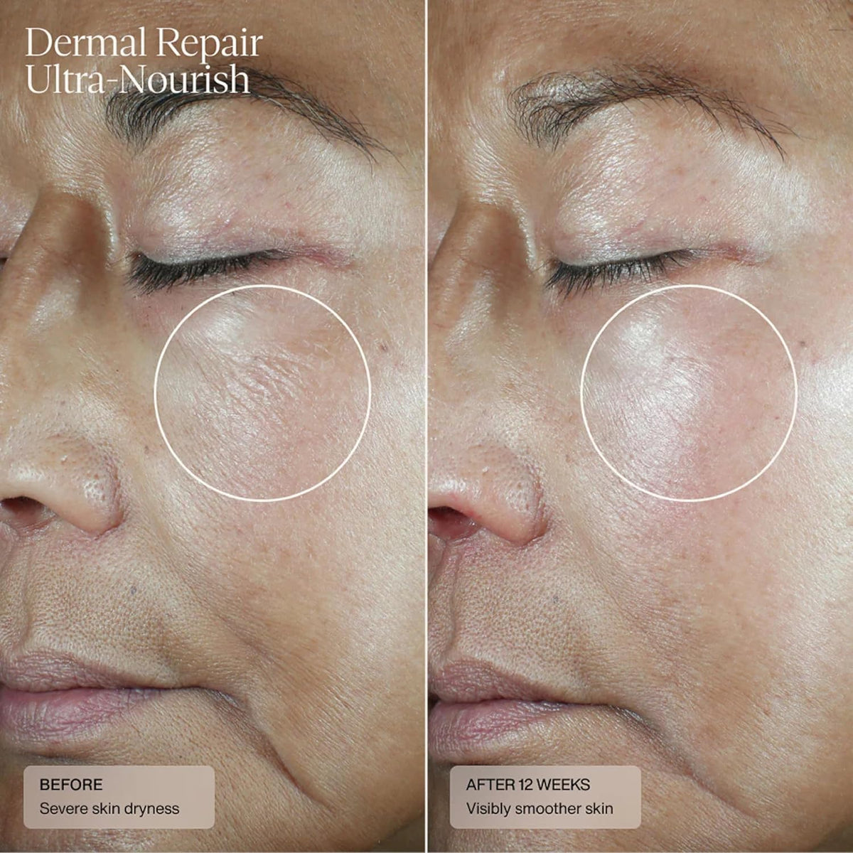 Senté Dermal Repair Ultra-Nourish - Rosacea Treatment For Dry, Sensitive Skin | Repairs, Replenishes & Reduces Skin Redness - 1.7 Fl Oz